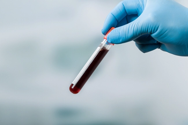 hand with glove holds a blood sample