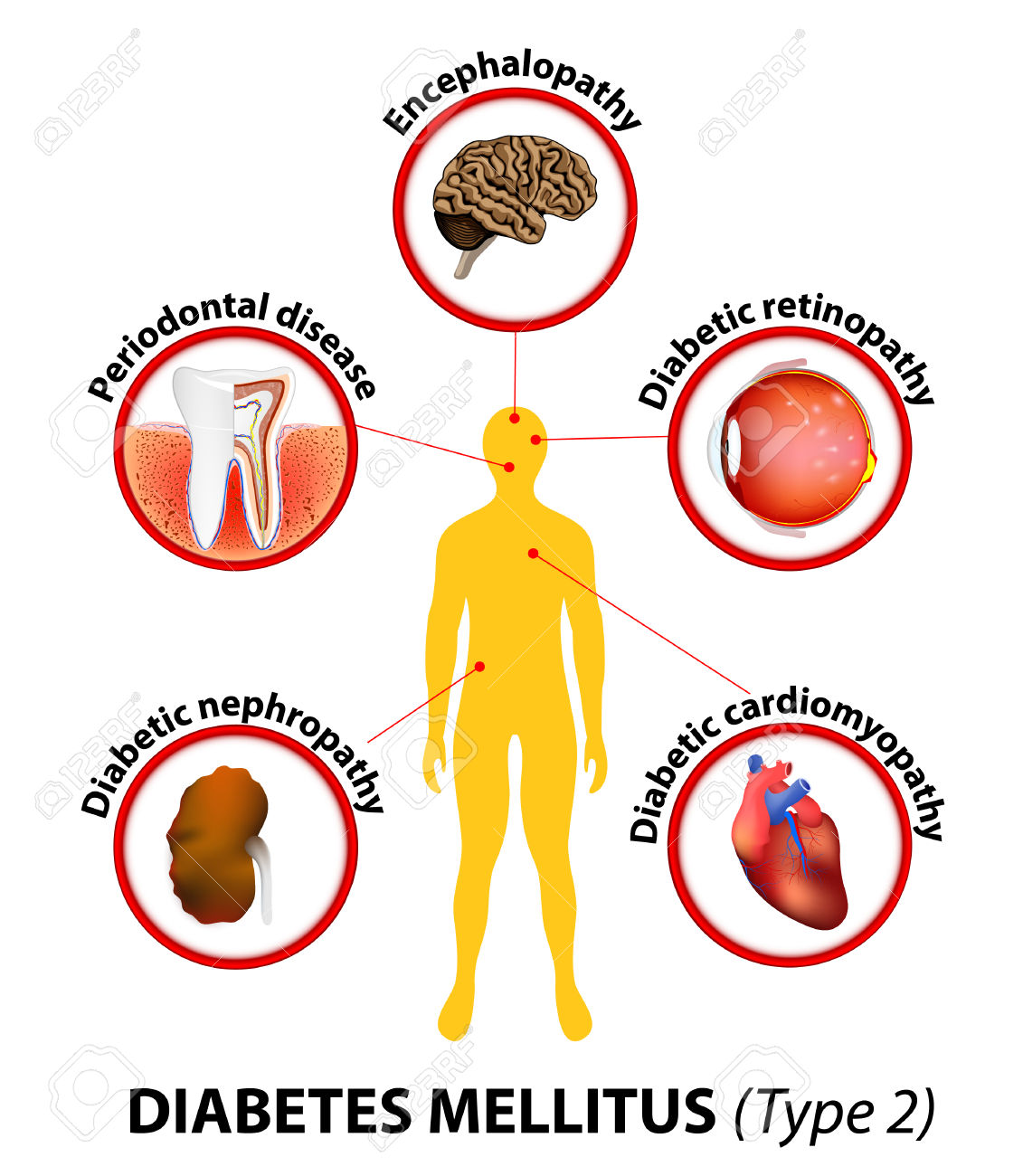 Diabetes Mellitus Type 2 Affected Organs Untreated Diabetes Can Cause