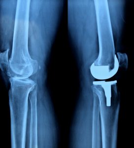 Knee xray 272x300