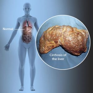 cirrhosis s1 facts 300x300