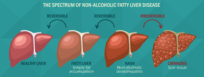 nafld