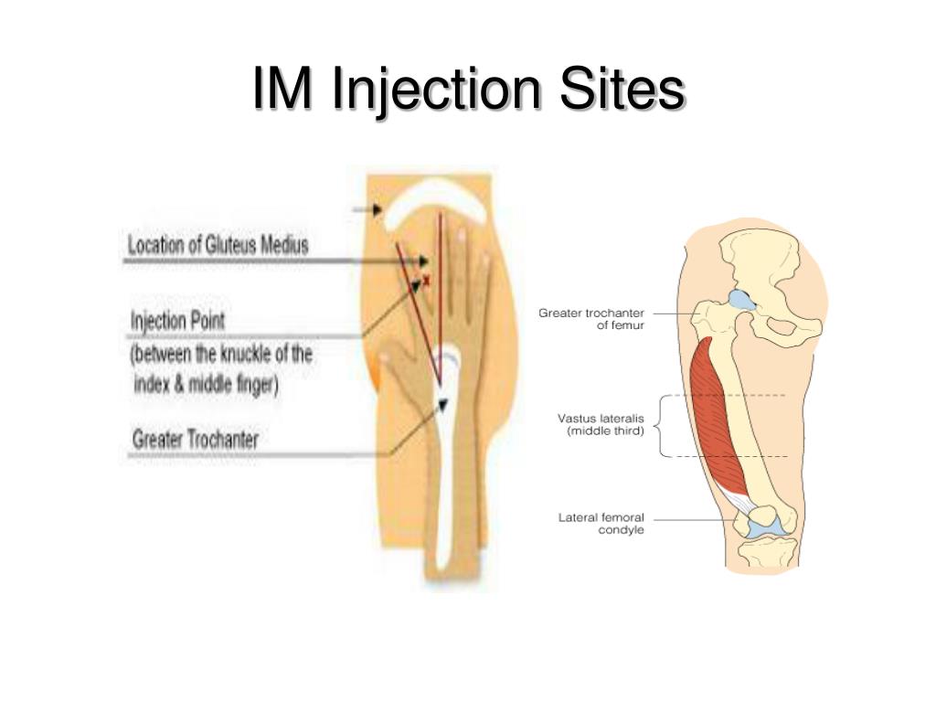 intramuscular injection sites