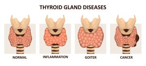 Thyroid gland diseases 300x136